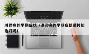 淋巴癌的早期症状（淋巴癌的早期症状图片能治好吗）